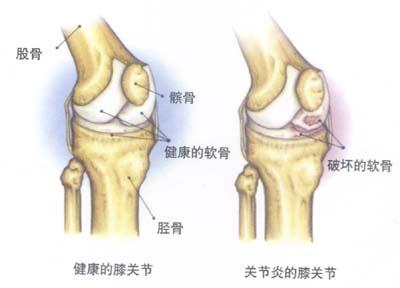 有机锗治疗风湿性关节炎